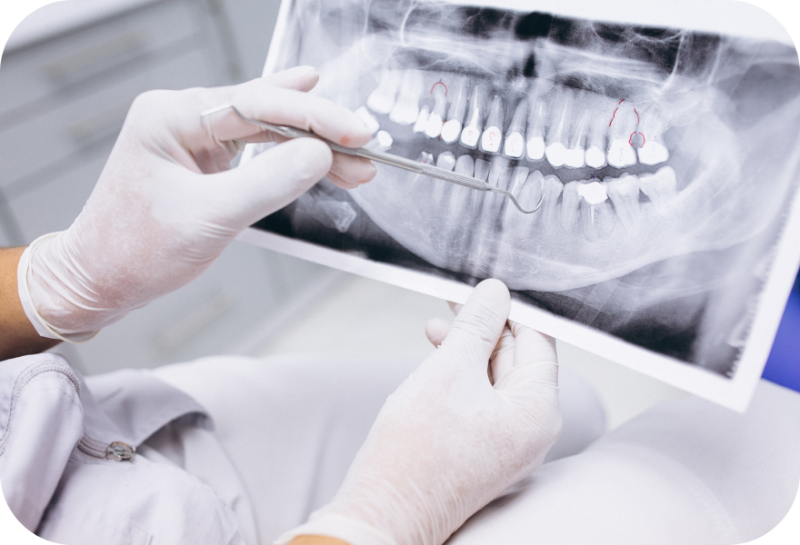Avulsion dentaire chirurgicale à Genève avec analyse radiographique préopératoire