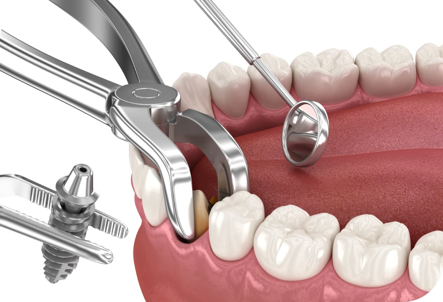 Extraction implantation immédiate Drs. Arnaud, Hugentobler & Oeggerli, Chirurgie orale | Genève