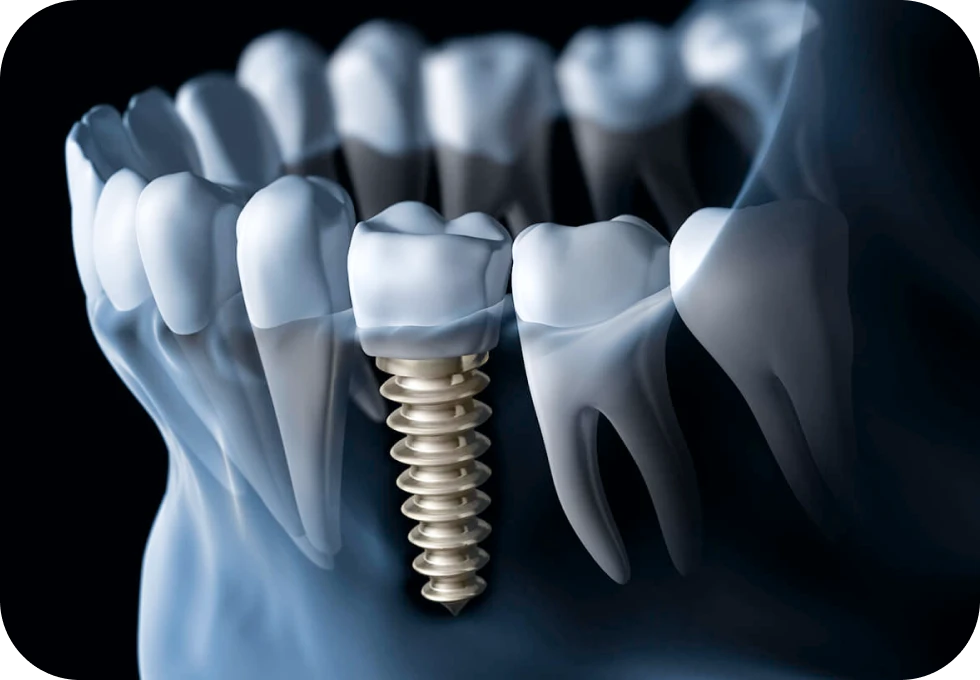 Implant unitaire Drs. Arnaud, Hugentobler & Oeggerli, Chirurgie orale | Genève