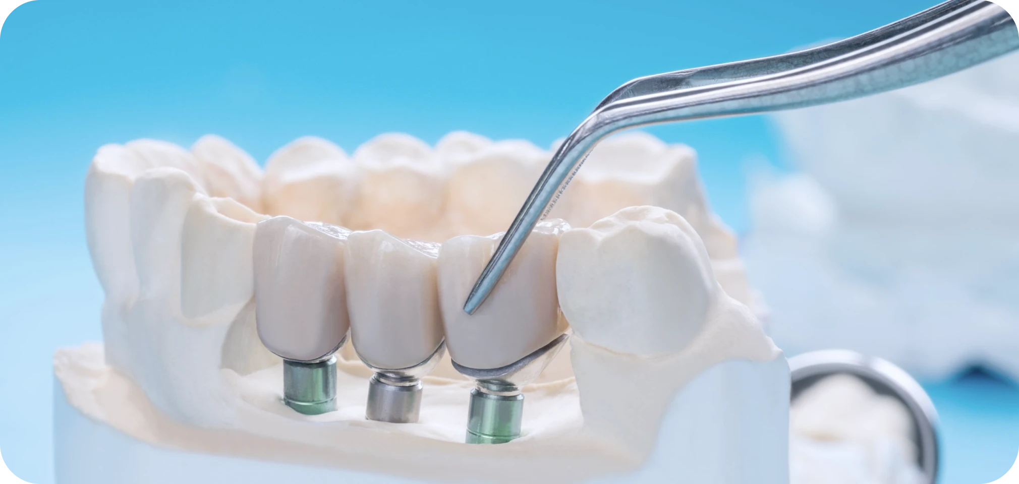 Implant unitaire Drs. Arnaud, Hugentobler & Oeggerli, Chirurgie orale | Genève
