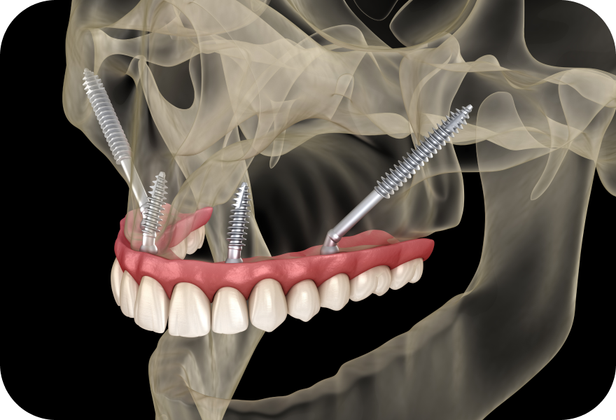 Implants zygomatiques à Genève pour réhabilitation complète du maxillaire supérieur