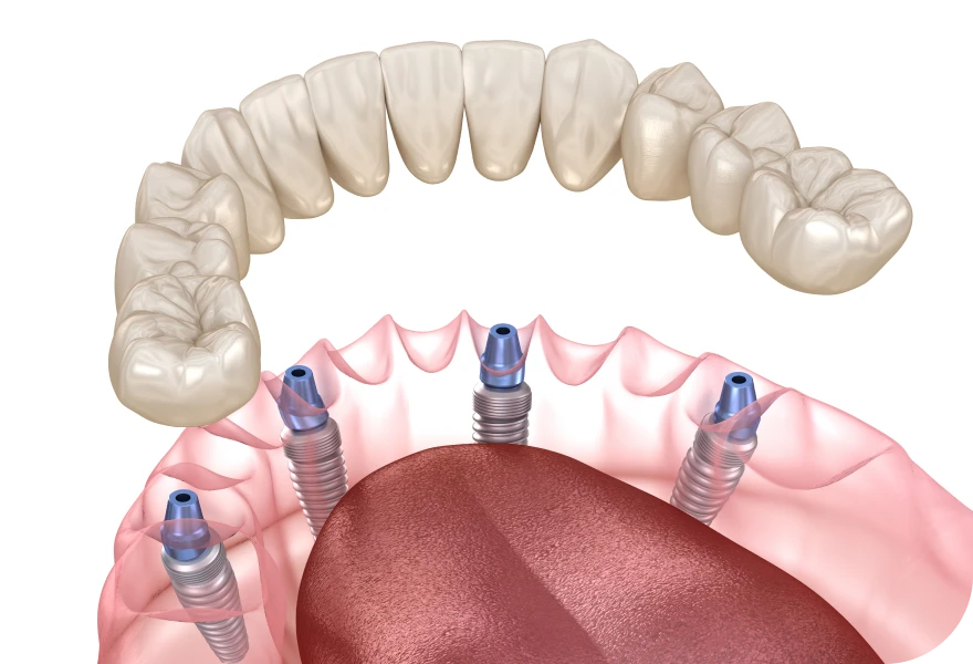 Traitement édenté complet, Dr. Arnaud, chirurgien oral à Genève