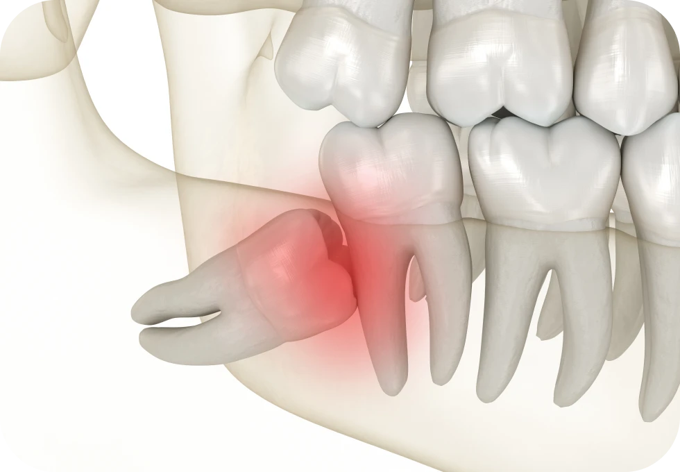 Dents de sagesse Drs. Arnaud, Hugentobler & Oeggerli, Chirurgie orale | Genève