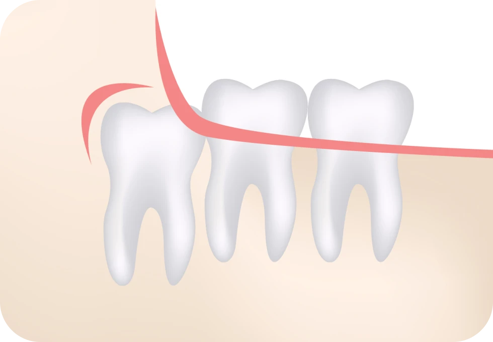 Dents de sagesse Drs. Arnaud, Hugentobler & Oeggerli, Chirurgie orale | Genève