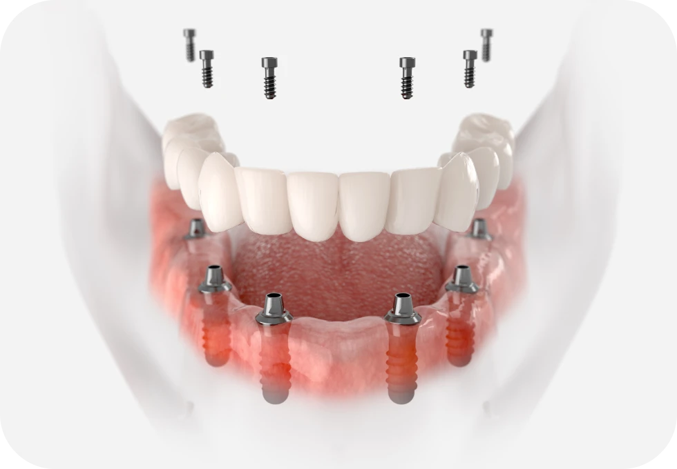 All-on-X Drs. Arnaud, Hugentobler & Oeggerli, Chirurgie orale | Genève