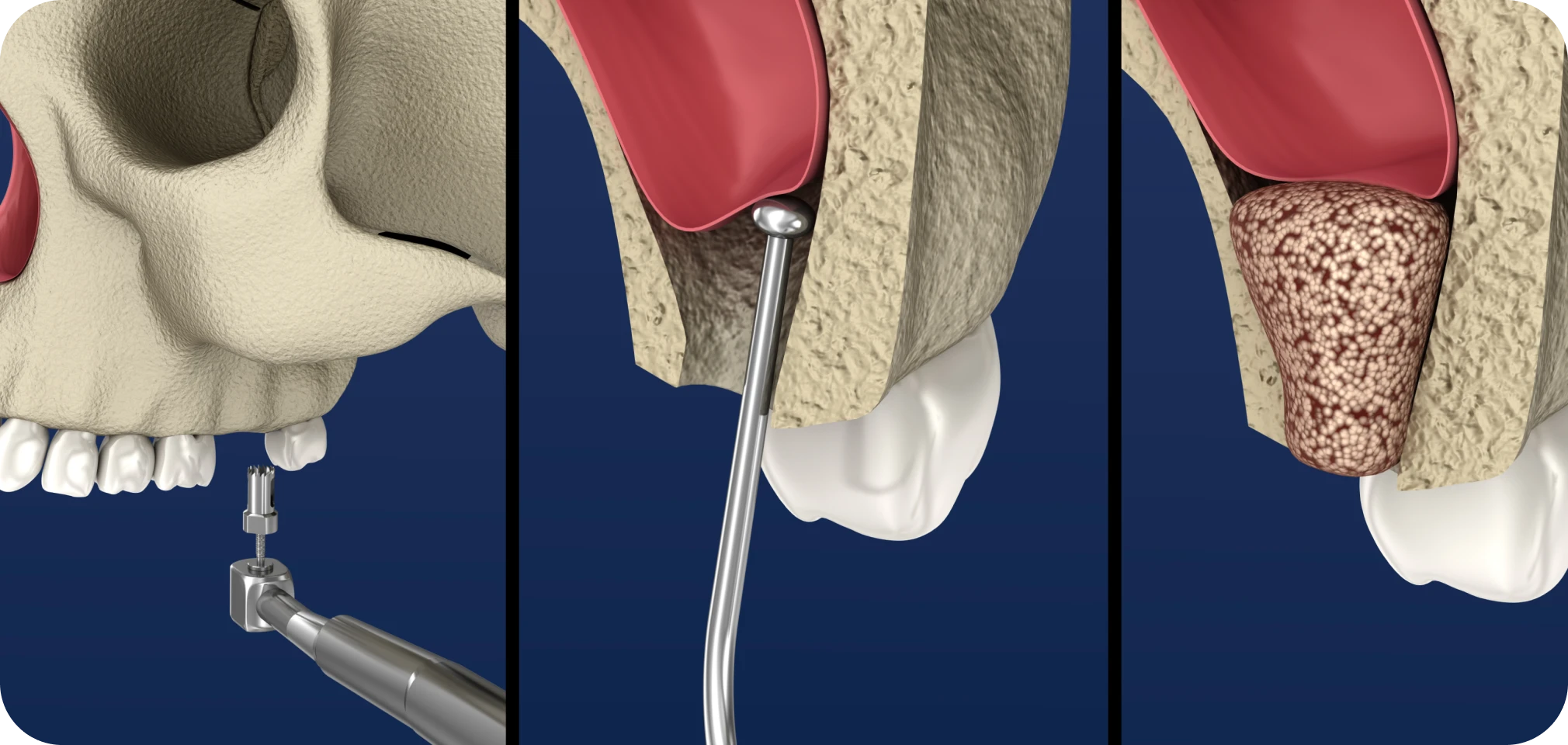 Communications bucco-sinusiennes Drs. Arnaud, Hugentobler & Oeggerli, Chirurgie orale | Genève