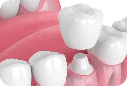 Mise en charge immédiate Drs. Arnaud, Hugentobler & Oeggerli | Oral Surgery | Geneva