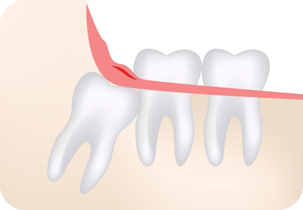 Dents de sagesse Drs. Arnaud, Hugentobler & Oeggerli, Chirurgie orale | Genève