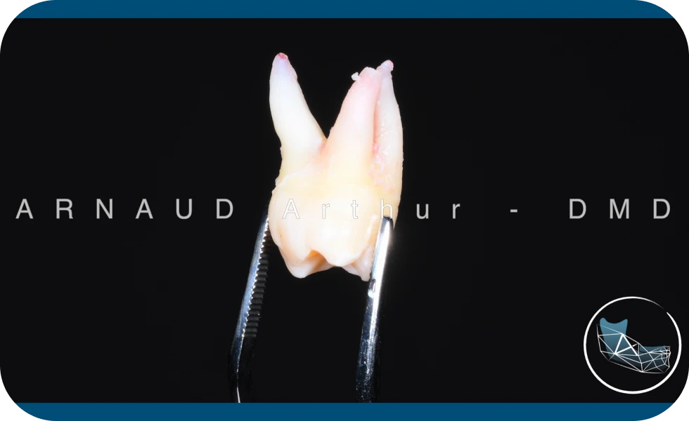 Dr. Arnaud, chirurgien oral à Genève : dents de sagesse