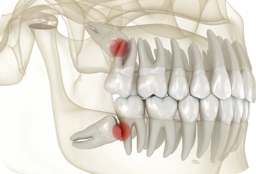 Dents de sagesse, Dr. Arnaud, chirurgien oral à Genève