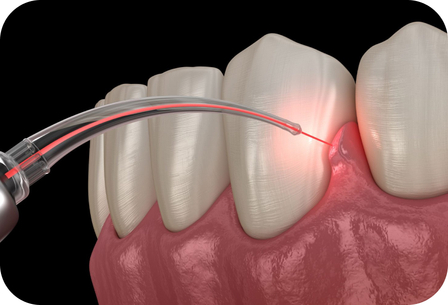 Frénectomie à Genève par laser pour traiter un frein buccal gênant