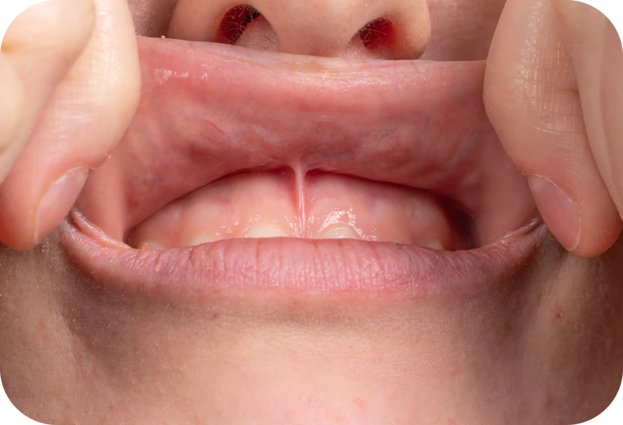 Frénectomie Drs. Arnaud, Hugentobler & Oeggerli, Chirurgie orale | Genève