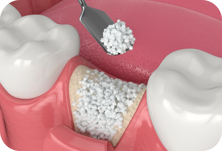 Greffe osseuse Drs. Arnaud, Hugentobler & Oeggerli, Chirurgie orale | Genève