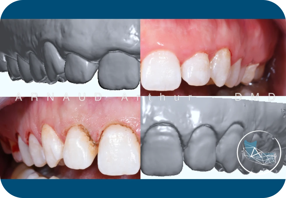 Gingivectomie esthétique Drs. Arnaud, Hugentobler & Oeggerli | Oral Surgery | Geneva