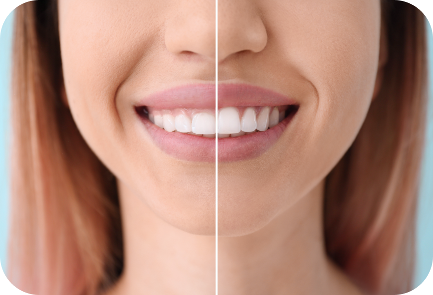 sourire gingival docteur arthur arnaud geneve morges Gingivectomie esthétique Drs. Arnaud, Hugentobler & Oeggerli, Chirurgie orale | Genève