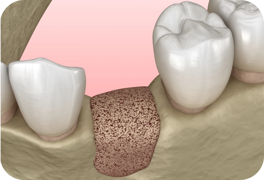 Greffe osseuse, chirurgie orale à Genève, chirurgien oral Dr. Arnaud