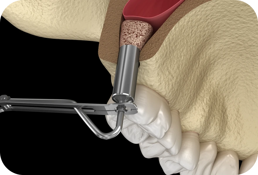 Sinus Lift, chirurgie orale à Genève