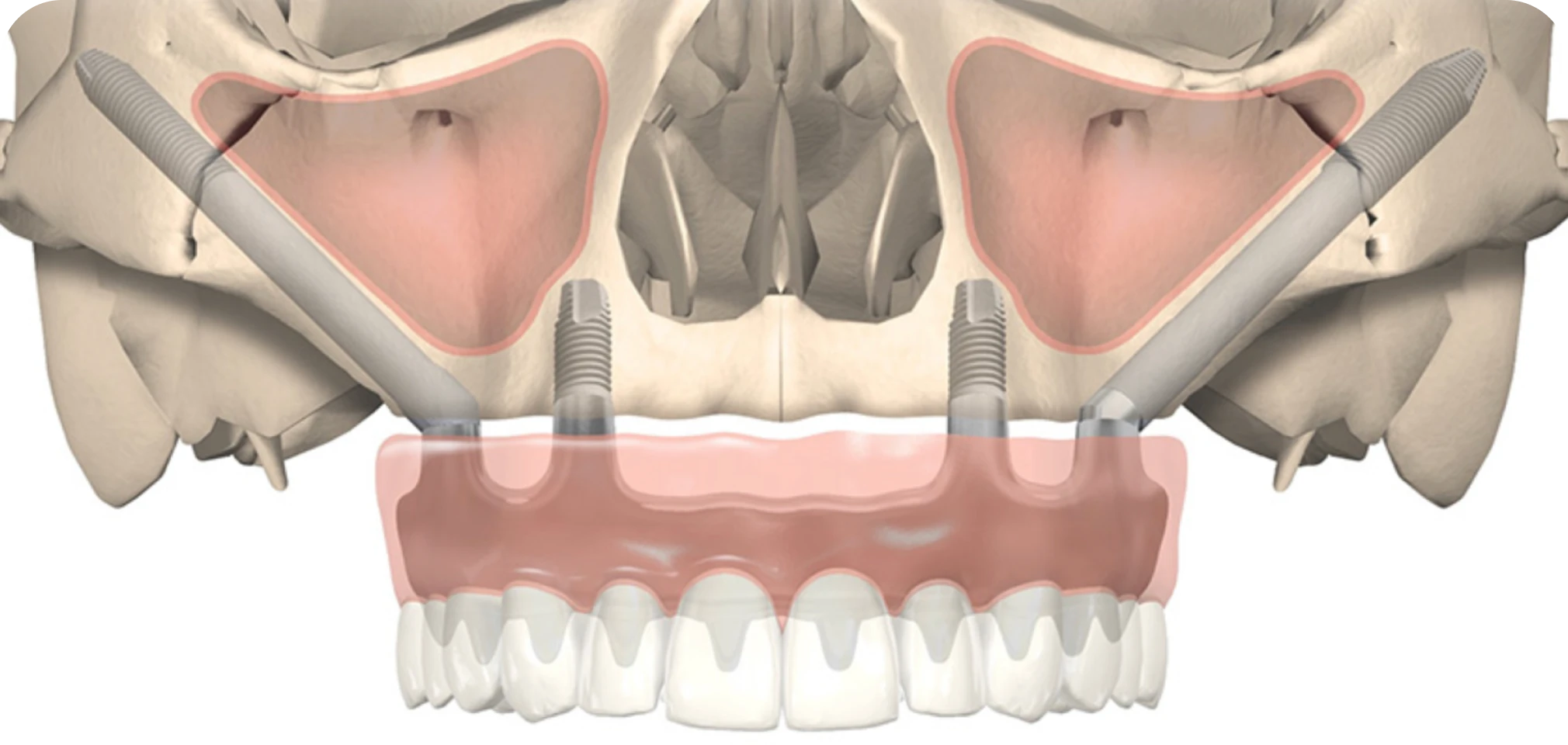 Implants zygomatiques Drs. Arnaud, Hugentobler & Oeggerli, Chirurgie orale | Genève