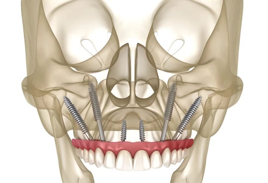 Implants zygomatiques Drs. Arnaud, Hugentobler & Oeggerli, Chirurgie orale | Genève
