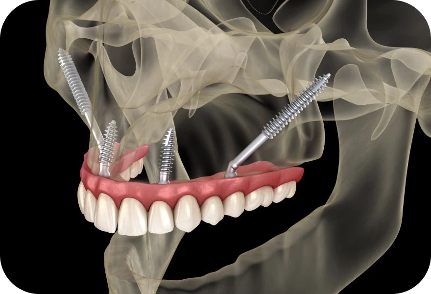 Docteur Arthur Arnaud, chirurgien oral à Genève : implants zygomatiques