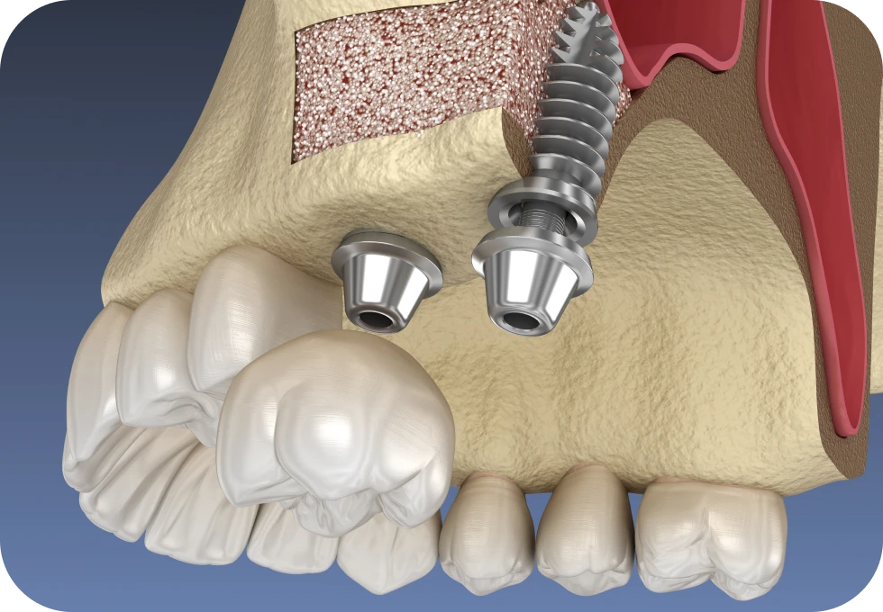 Sinus lift Drs. Arnaud, Hugentobler & Oeggerli, Chirurgie orale | Genève