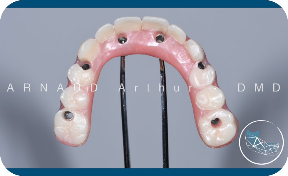 prothese totale amovible chirurgien oral docteur arnaud All-on-X Drs. Arnaud, Hugentobler & Oeggerli, Chirurgie orale | Genève