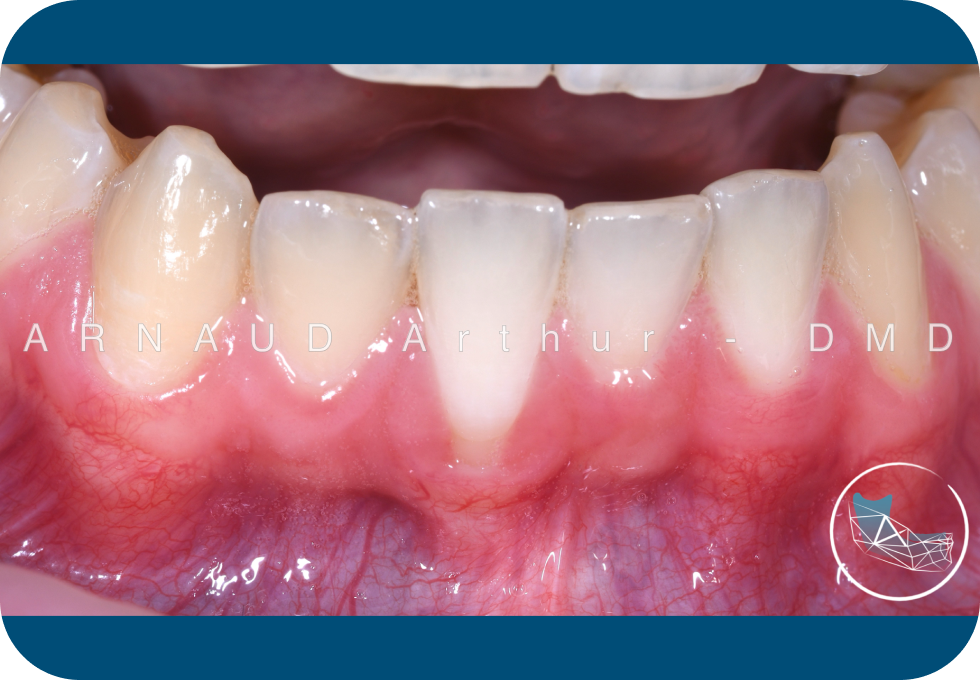 Résultat clinique d’une greffe gingivale sur les dents antérieures inférieures à Genève