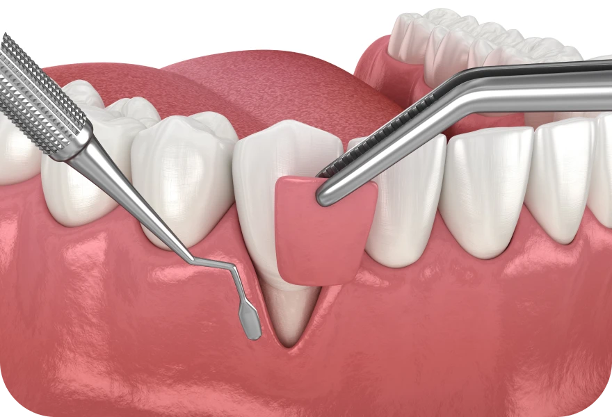 Greffe gingivale Drs. Arnaud, Hugentobler & Oeggerli | Oral Surgery | Geneva