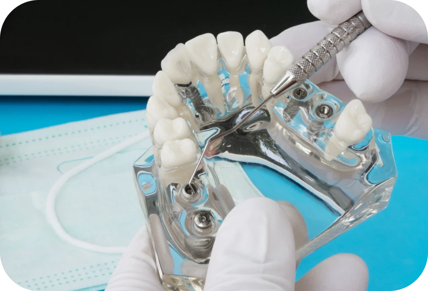 Les implants sous-périostés Drs. Arnaud, Hugentobler & Oeggerli | Oral Surgery | Geneva