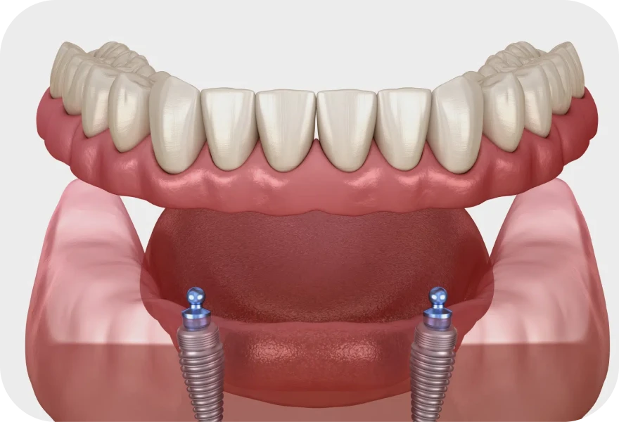 Prothèse complète stabilisée sur implants Drs. Arnaud, Hugentobler & Oeggerli | Oral Surgery | Geneva