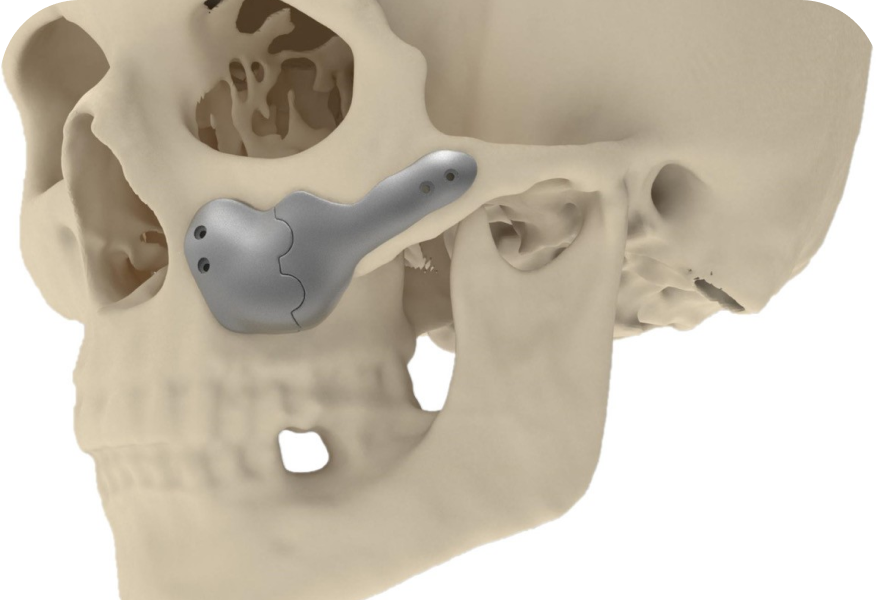 Implants faciaux Drs. Arnaud, Hugentobler & Oeggerli | Oral Surgery | Geneva