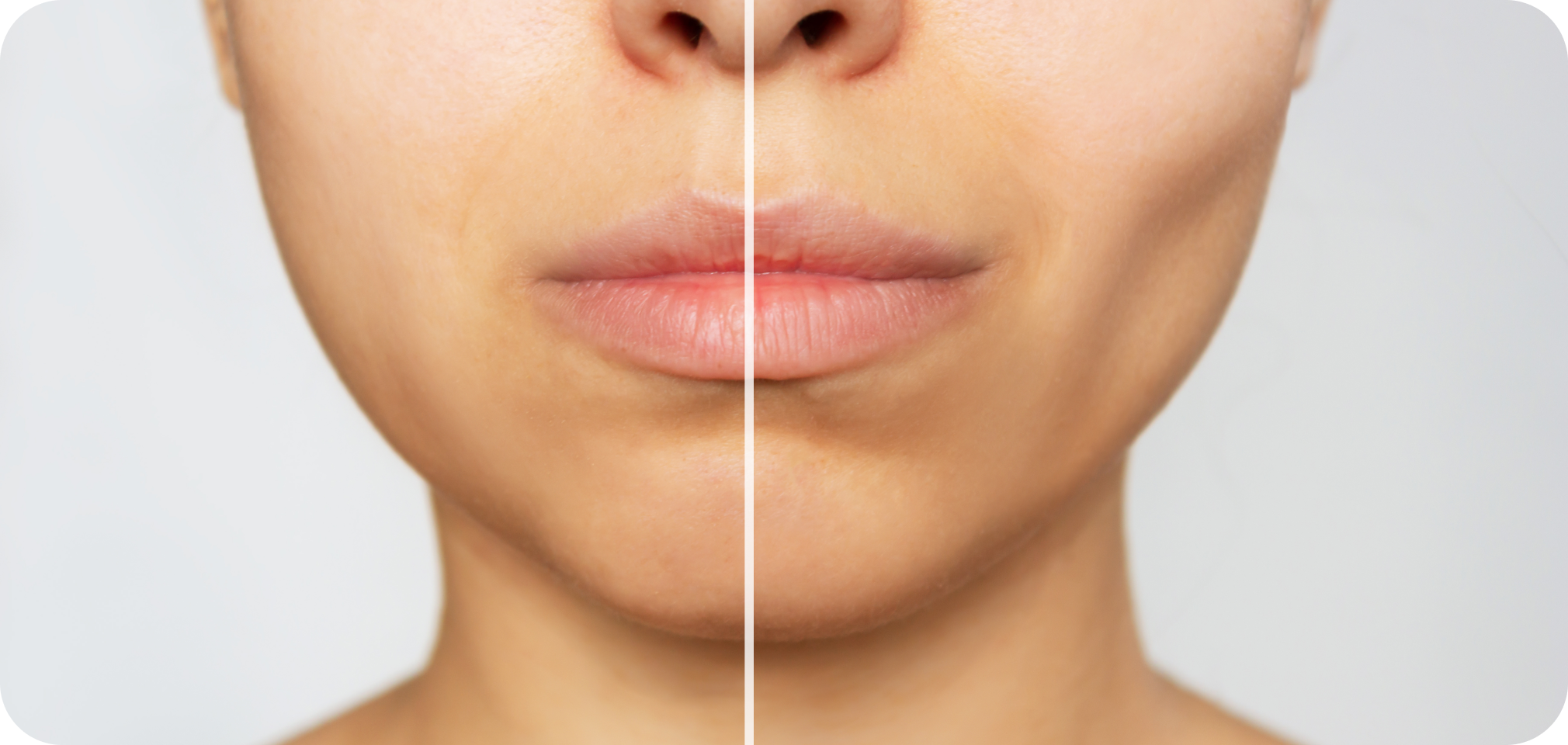 Bichectomie Drs. Arnaud, Hugentobler & Oeggerli, Chirurgie orale | Genève